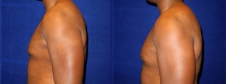 Left Profile View - Gynecomastia