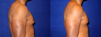 Right Profile View - Gynecomastia