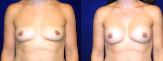 Frontal View - Breast Augmentation - Silicone Implants