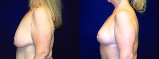 Left Profile View - Breast Lift After Massive Weight Loss