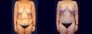 Frontal View - Body Lift After Massive Weight Loss