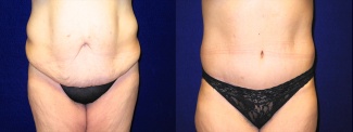 Frontal View - Tummy Tuck After Massive Weight Loss