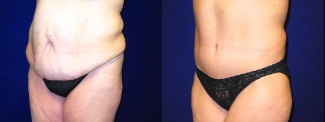 Left 3/4 View - Tummy Tuck After Massive Weight Loss