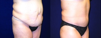 Right 3/4 View - Tummy Tuck After Massive Weight Loss