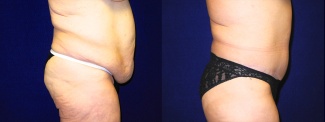 Right Profile View - Tummy Tuck After Massive Weight Loss