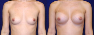 Frontal View - Breast Augmentation