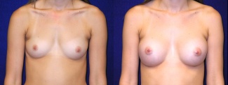 Frontal View - Breast Augmentation - Silicone Implants