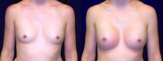 Frontal View Breast Augmentation - Breast Asymmetry