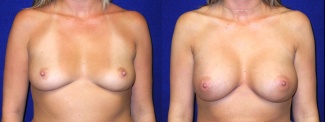 Frontal View - Breast Augmentation - Silicone Implants