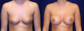 Frontal View - Breast Augmentation - Silicone Implants