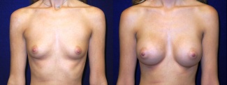 Frontal View - Breast Augmentation - Silicone Implants