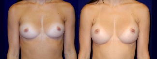 Frontal View - Breast Augmentation - Silicone Implants