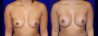 Frontal View - Breast Augmentation - Breast Asymmetry Correction