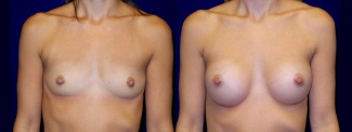 Frontal View - Breast Augmentation - Silicone Implants