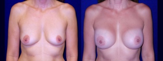 Frontal View - Breast Augmentation After Pregnancy - Silicone Implants