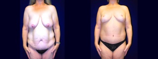 Frontal View - Body Lift After Massive Weight Loss