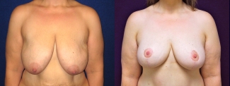 Frontal View - Breast Lift After Massive Weight Loss