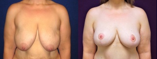 Frontal View - Breast Lift After Massive Weight Loss