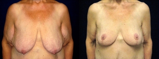 Frontal View - Breast Reduction Mastopexy and Arm Lift After Massive Weight Loss