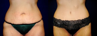 Frontal View - Circumferential Abdominoplasty After Massive Weight Loss
