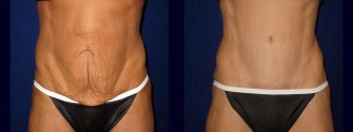 Frontal View - Tummy Tuck After Massive Weight Loss