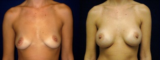 Frontal View - Breast Augmentation - Silicone Implants