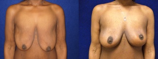 Frontal View - Breast Lift and Arm Lift After Massive Weight Loss