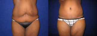 Frontal View - Tummy Tuck After Massive Weight Loss