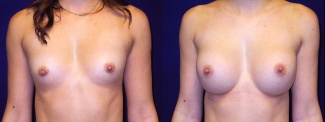 Frontal View - Breast Augmentation - Silicone Implants