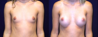 Frontal View - Breast Augmentation - Silicone Implants