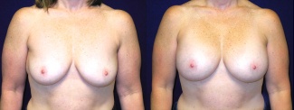 Frontal View - Breast Augmentation After Weight Loss - Silicone Implants
