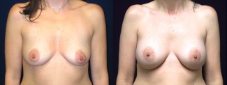 Frontal View - Breast Augmentation After Pregnancy - Silicone Implants