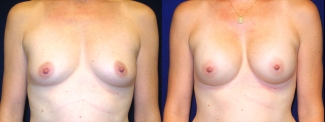 Frontal View - Breast Augmentation After Pregnancy - Silicone Implants