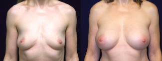 Frontal View - Breast Augmentation - Silicone Implants