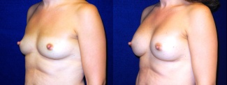 Left 3/4 View - Breast Augmentation - Silicone Implants