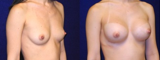 Right 3/4 View - Breast Augmentation