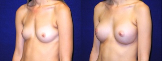 Left 3/4 View - Breast Augmentation - Silicone Implants