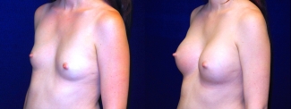 Left 3/4 View Breast Augmentation - Breast Asymmetry