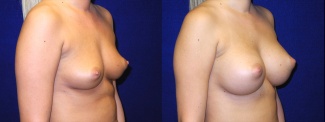 Right 3/4 View - Breast Augmentation - Silicone Implants