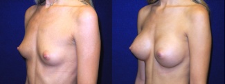 Left 3/4 View - Breast Augmentation - Silicone Implants