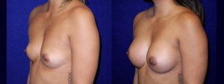 Left 3/4 View - Breast Augmentation - Breast Asymmetry Correction