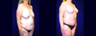 Right 3/4 View - Body Lift After Massive Weight Loss