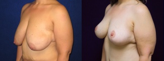 Left 3/4 View - Breast Lift After Massive Weight Loss