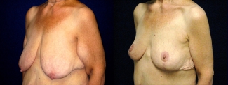 Left 3/4 View - Breast Reduction Mastopexy and Arm Lift After Massive Weight Loss