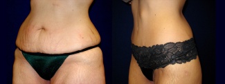 Left 3/4 View - Circumferential Abdominoplasty After Massive Weight Loss