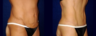 Right 3/4 View - Tummy Tuck After Massive Weight Loss