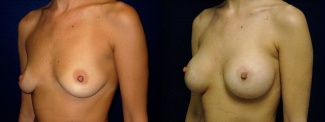 Left 3/4 View - Breast Augmentation - Silicone Implants