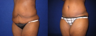 Left 3/4 View - Tummy Tuck After Massive Weight Loss