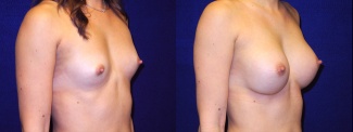 Right 3/4 View - Breast Augmentation - Silicone Implants