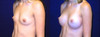 Left 3/4 View - Breast Augmentation - Silicone Implants